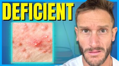 The #1 Cause of Acne in Adults (how to stop it)