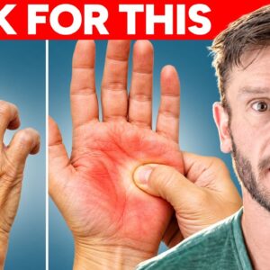 4 Signs Your Hands are Telling You About Insulin Resistance and Your Liver