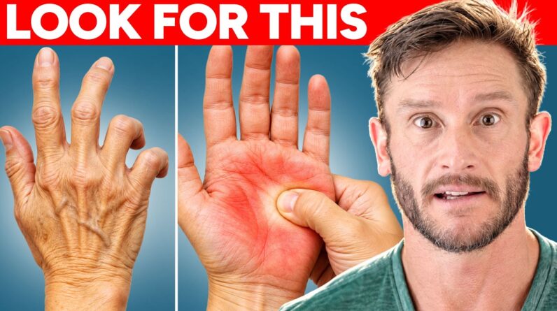 4 Signs Your Hands are Telling You About Insulin Resistance and Your Liver